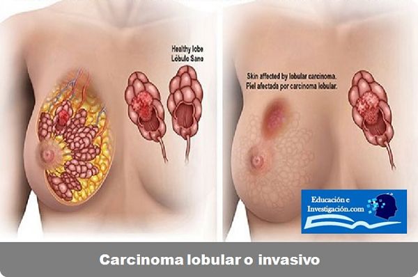 Uno de los tipos de cáncer Carcinoma lobular o invasivo