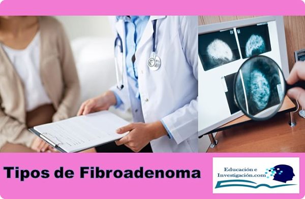Tipos de Fibroadenoma de mama